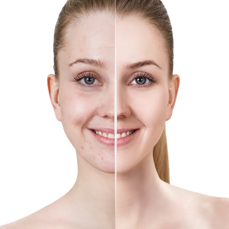 before-and-after-moisturising-soap-skin-results Before and after skincare comparison showing acne mark reduction and smooth radiant complexion achieved with daily moisturising soap use